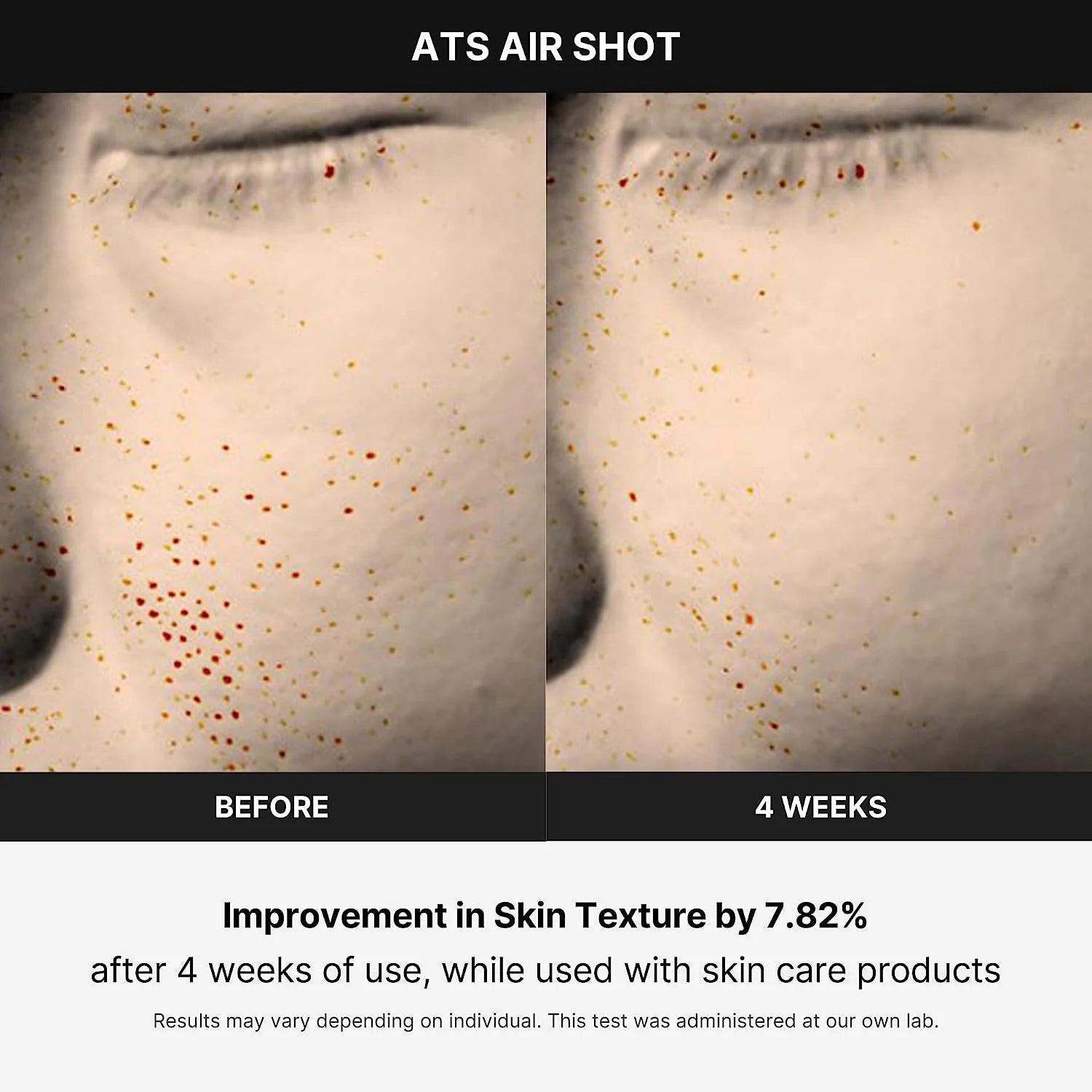 Age-R ATS Air Shot - Microneedling Pore Tightening Skin Care Device for Enhanced Absorption, Pore Refinement, and Smoother Skin Texture